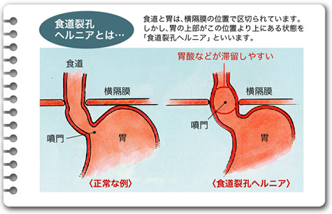 食道裂孔ヘルニアとは・・・食道と胃は、横隔膜の位置で区切られています。しかし、胃の上部がこの位置より上にある状態を「食道裂孔ヘルニア」といいます。